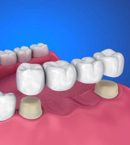 Illustrated dental bridge in New York replacing two missing teeth