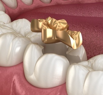 Illustrated gold filling being placed onto a tooth