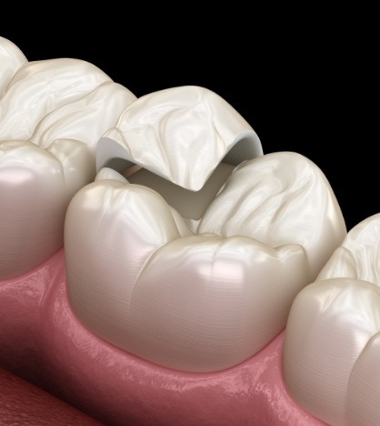 Illustrated dental onlay being placed on the cusp of a broken tooth