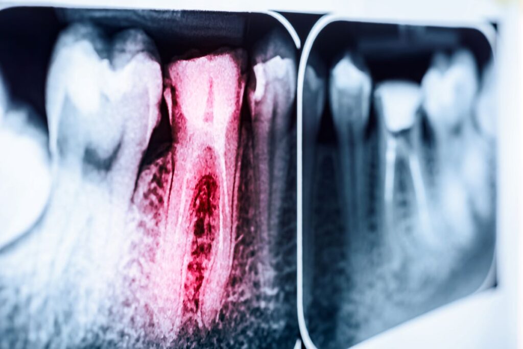 An X-ray image of an infected tooth.