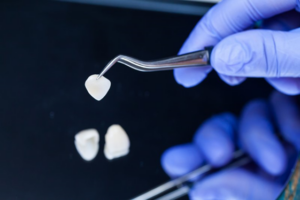 Close up of dentist carefully handling dental veneers